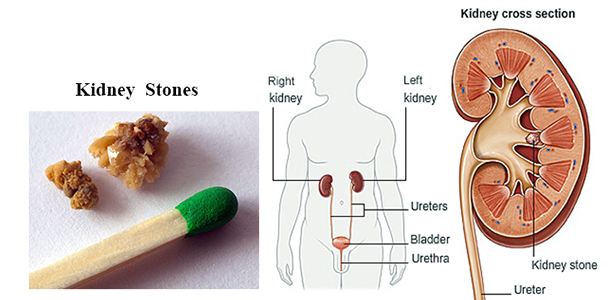 Kidney stones